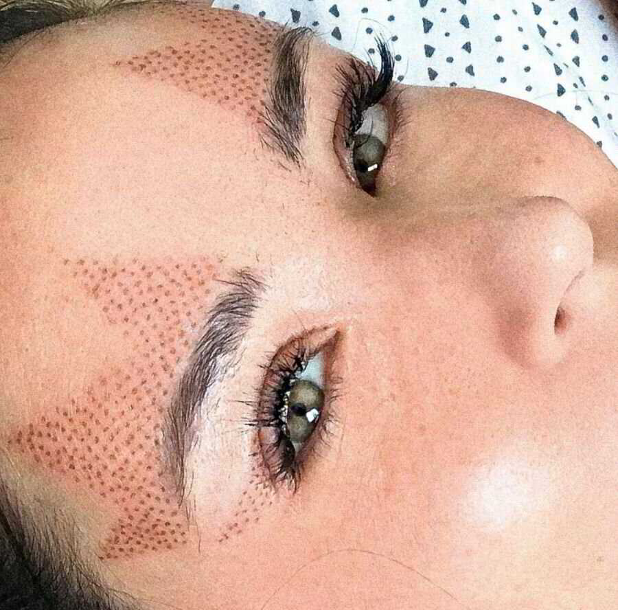 Fibroblast